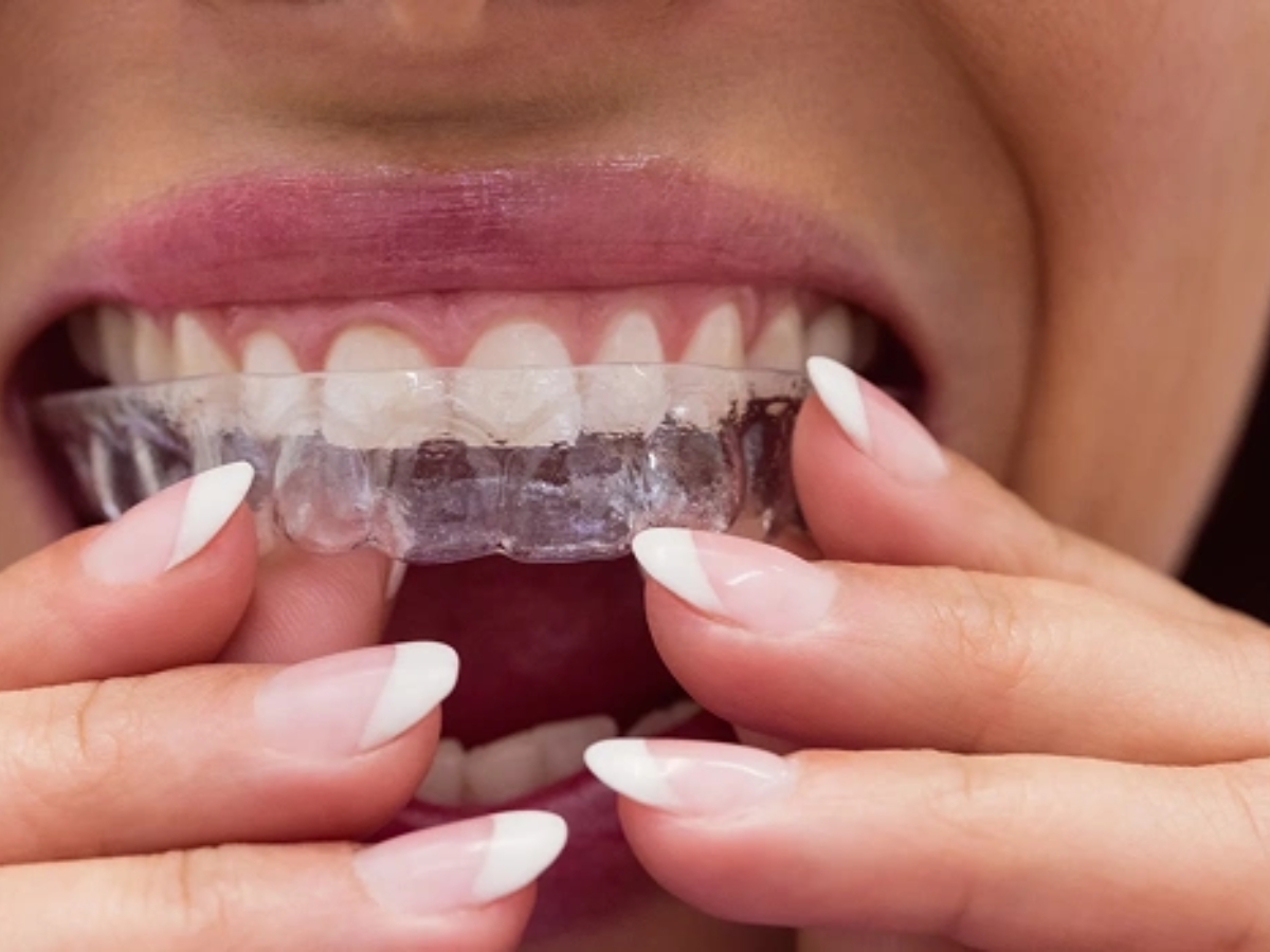 Alinhadores Invisíveis e Aparelhos Ortodônticos Benefícios, diferenças e resultados em Maceió e Milagres.